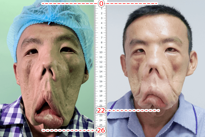 Khát khao của chàng trai mặt quỷ, 15 năm ngủ ngồi - Ảnh 1.