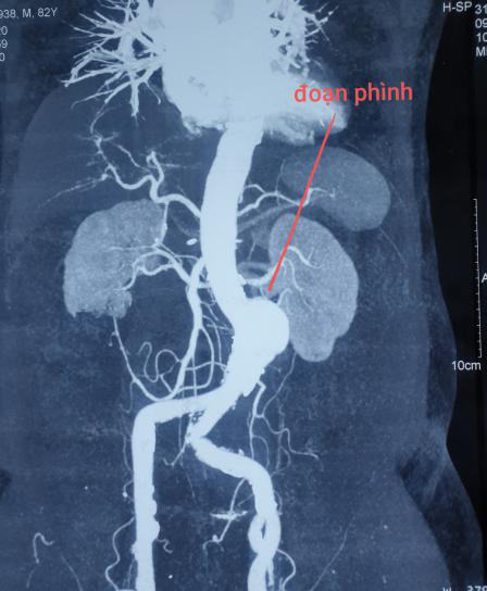 Nhờ đặt stent graft, cụ ông 82 tuổi thoát khối u có mạch đập tại bụng - Ảnh 1.