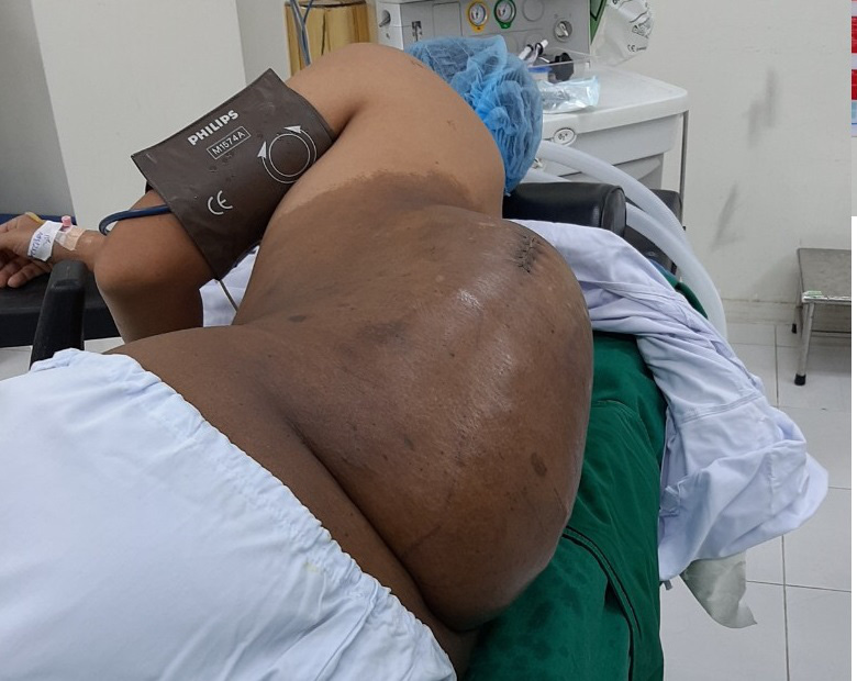 Lúc đầu bằng hạt mít, khối u bất ngờ nặng hơn 4kg trên lưng nam thanh niên