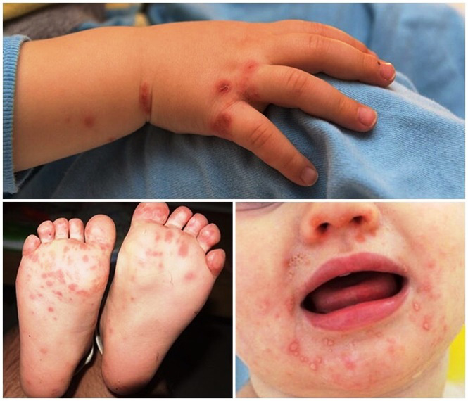 Bệnh tay chân miệng trẻ em bùng phát ở Lâm Đồng