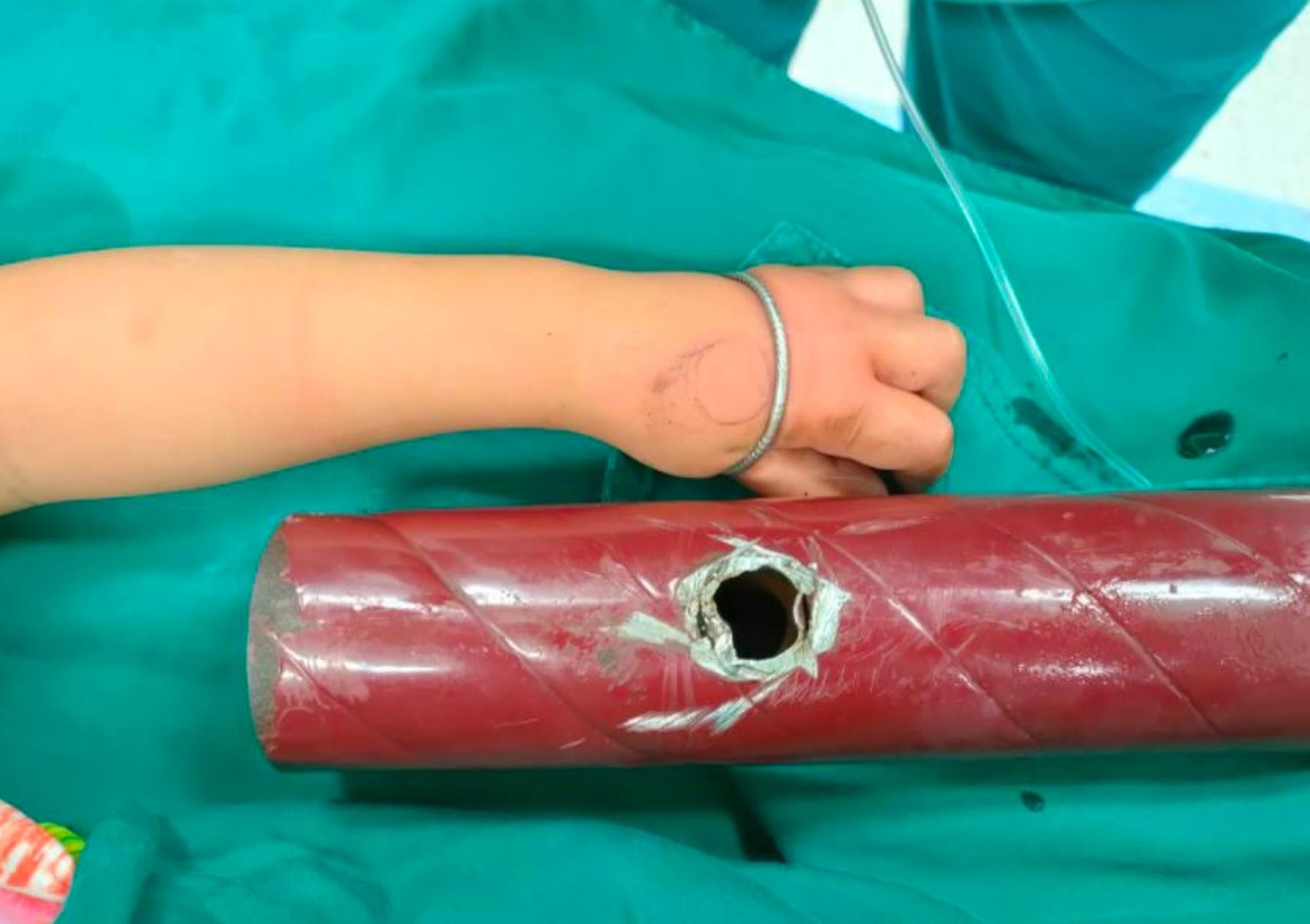 Bé gái vào bệnh viện với tay kẹt trong ống chân giường sắt