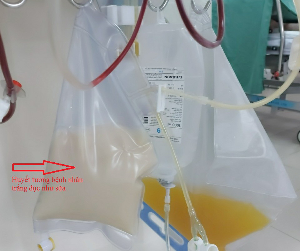 Su&yacute;t chết v&igrave; tăng mỡ m&aacute;u si&ecirc;u khủng, huyết thanh c&oacute; m&agrave;u trắng như sữa - Ảnh 1.