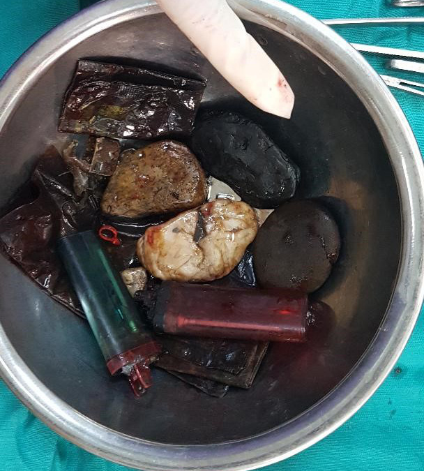 Người đàn ông nuốt dị vật như bật lửa, sỏi đá, dao lam vào bụng - Ảnh 3.