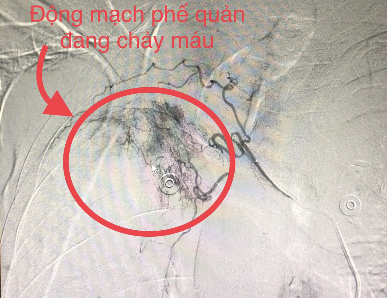 Cứu sống 2 người đ&agrave;n &ocirc;ng ở Quảng B&igrave;nh bị ho ra m&aacute;u s&eacute;t đ&aacute;nh trước&hellip;ph&uacute;t l&acirc;m nguy - Ảnh 2.