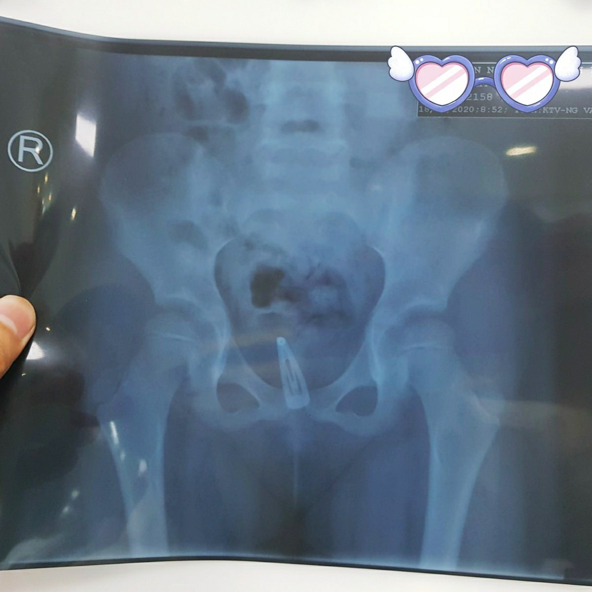 Kẹp t&oacute;c bằng kim loại nằm trong v&ugrave;ng k&iacute;n 3 th&aacute;ng  m&agrave;... kh&ocirc;ng biết! - Ảnh 1.