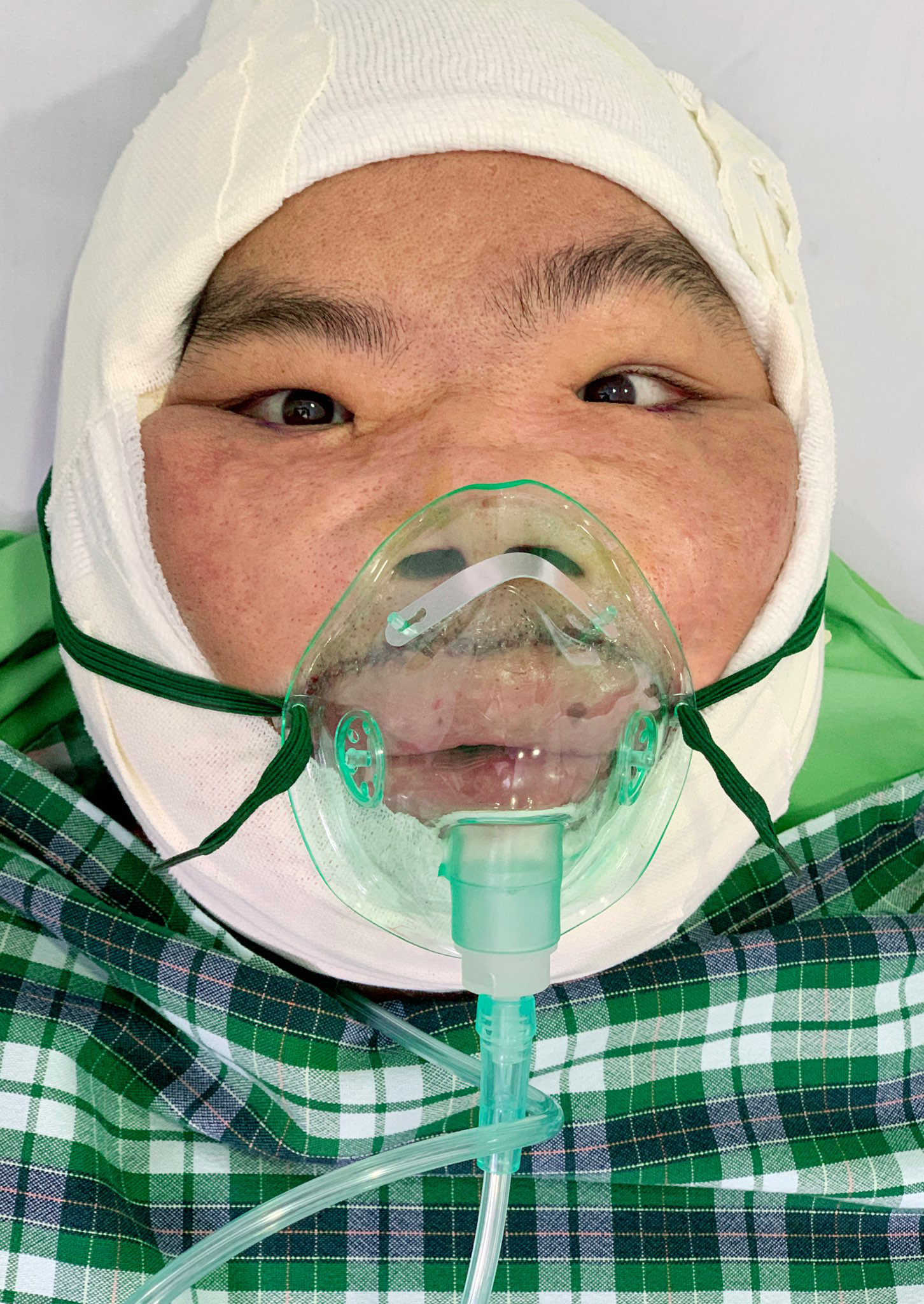 9 giờ cân não với chàng trai "mặt quỷ" lên bàn mổ lần 2