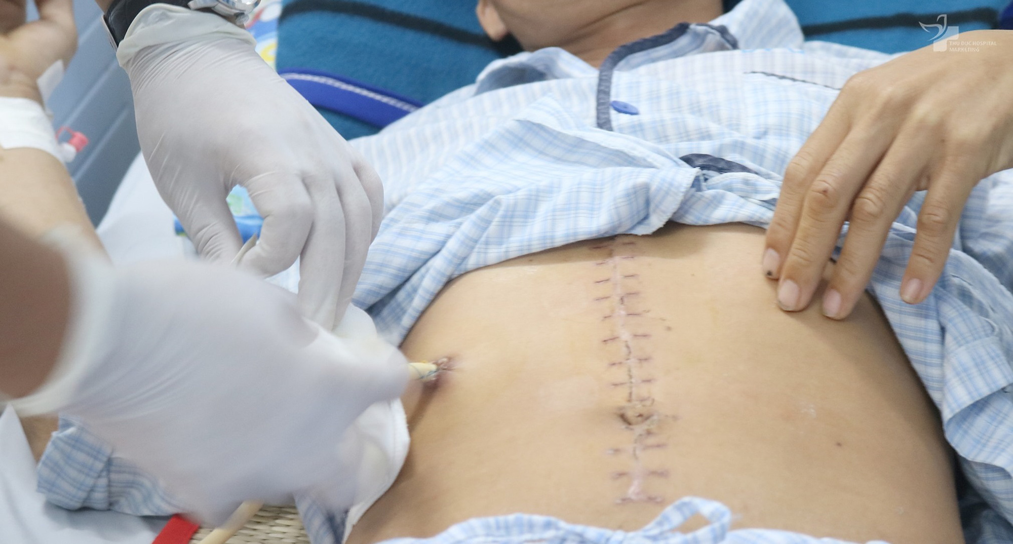 Khẩn cứu người đàn ông bị gạch đè vỡ tạng
