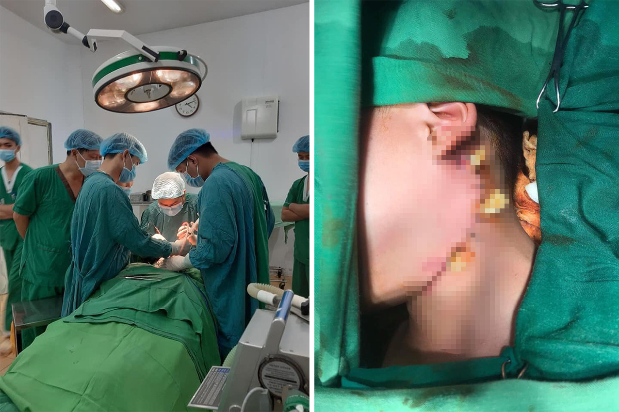 Tr&egrave;o c&acirc;y ng&atilde;, b&eacute; trai 12 tuổi bị c&agrave;nh c&acirc;y đ&acirc;m xuy&ecirc;n cổ - Ảnh 2.