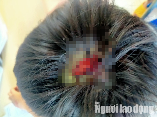 Bé 9 tuổi nghi bị cha bạo hành dã man