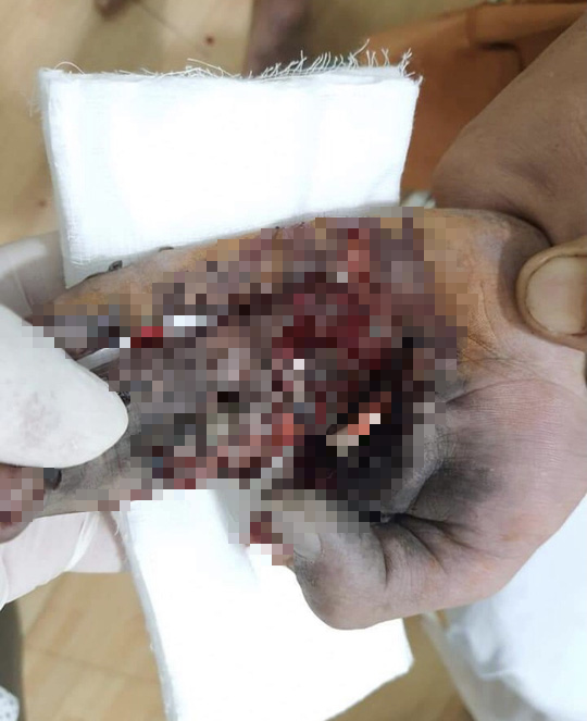 Sạc điện thoại, một thiếu niên bị nổ nát bàn tay