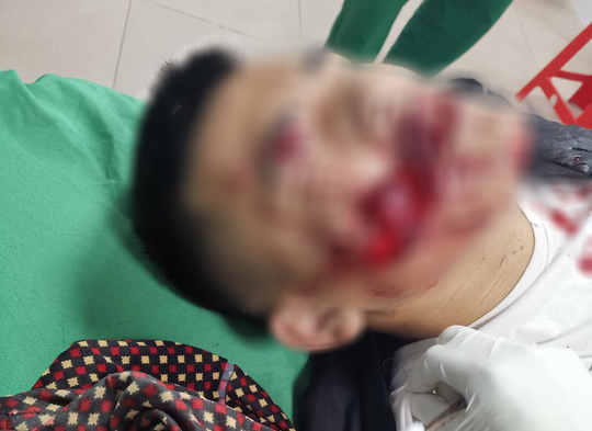 Nghịch pháo, 2 chú cháu bị pháo nổ dập nát bàn tay, bị thương vùng mặt