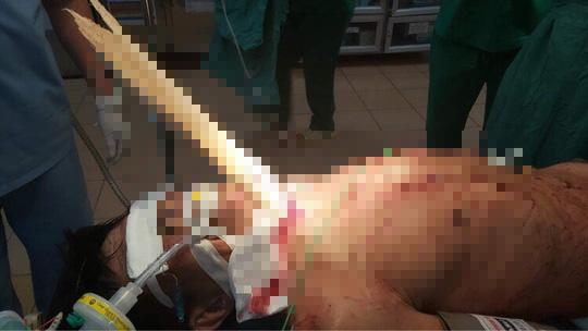 Cứu người đàn ông bị tai nạn hy hữu - thanh gỗ nửa mét đâm xuyên cổ