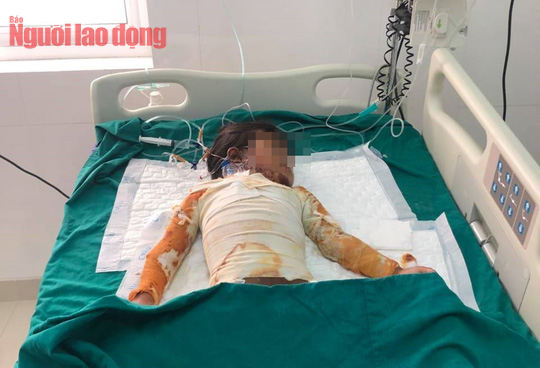 Bé gái 7 tuổi bị phỏng, gia đình đưa về nhà chờ chết: Rất cần sự giúp đỡ