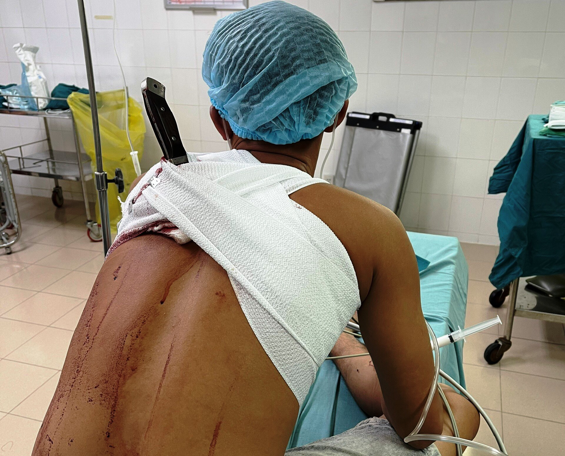 Sau hỗn chiến, nam thanh niên đến bệnh viện với cây dao đâm vào lưng