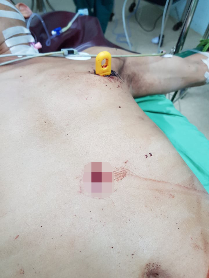 Cứu sống bệnh nhân bị đâm lút cán dao, làm thủng tim, gan