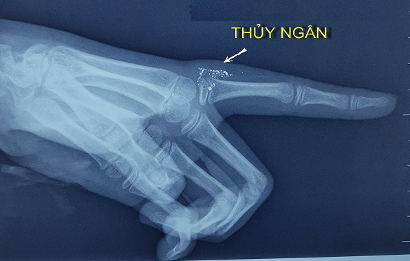 Hy hữu, bé gái 11 tuổi nhiễm độc thủy ngân do vỡ nhiệt kế - Ảnh 1.