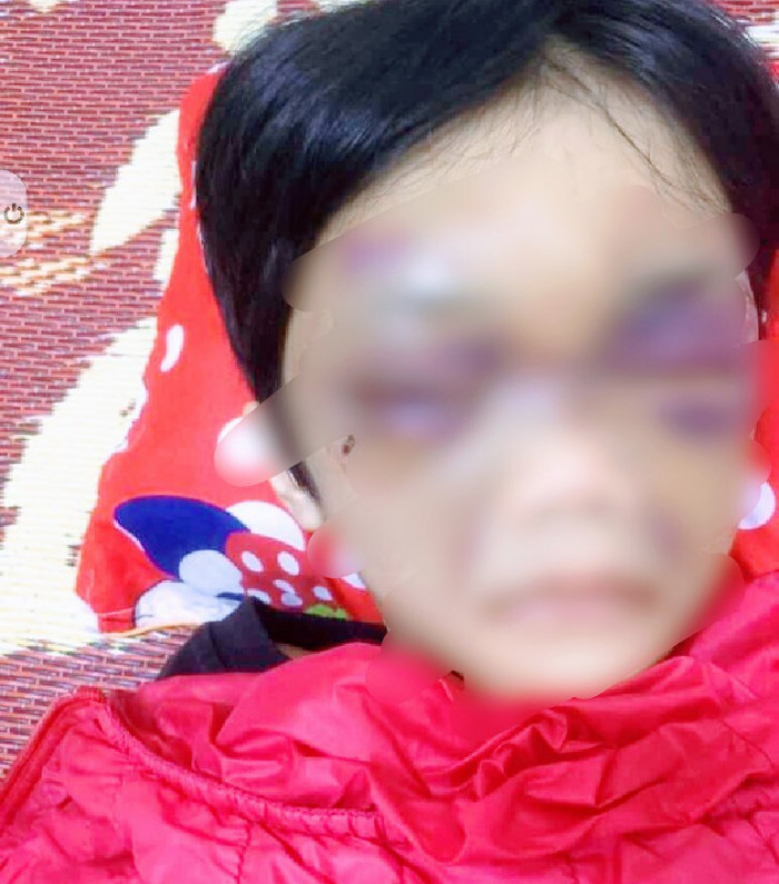 Mẹ đẻ bạo h&agrave;nh con g&aacute;i 6 tuổi th&acirc;m t&iacute;m mặt m&agrave;y, nhốt trong ph&ograve;ng trọ - Ảnh 1.