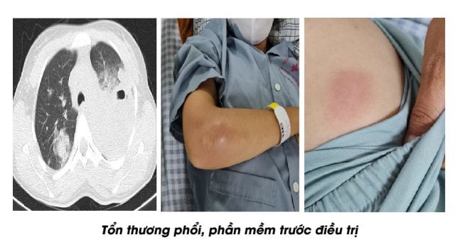 Sưng tấy v&ograve;ng 1, đi kh&aacute;m c&ocirc; g&aacute;i mới biết mắc bệnh truyền nhiễm nguy hiểm - Ảnh 1.