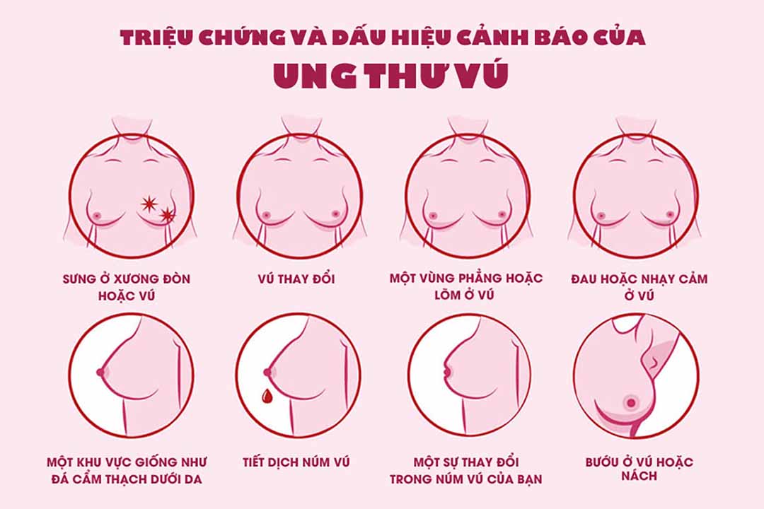 Thứ trưởng Bộ Y tế k&ecirc;u gọi chị em kh&aacute;m s&agrave;ng lọc bệnh ung thư v&uacute; - Ảnh 2.