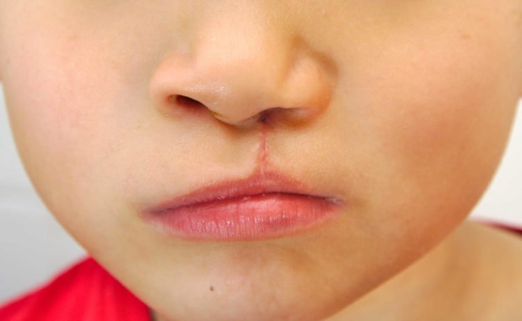 Bé mới sinh bị hở hàm ếch, khi nào thì phẫu thuật được?