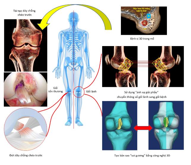 Vinmec tái tạo chính xác dây chằng chéo trước khớp gối với phương pháp “ánh xạ giải phẫu” độc quyền