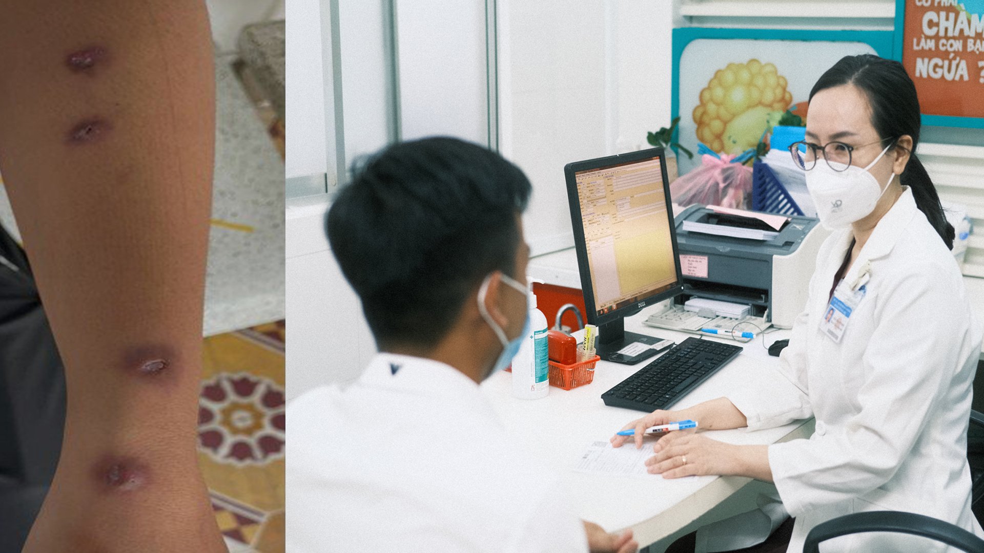 Nam thanh niên phát hiện bệnh lao da sau khi bị gai tôm đâm