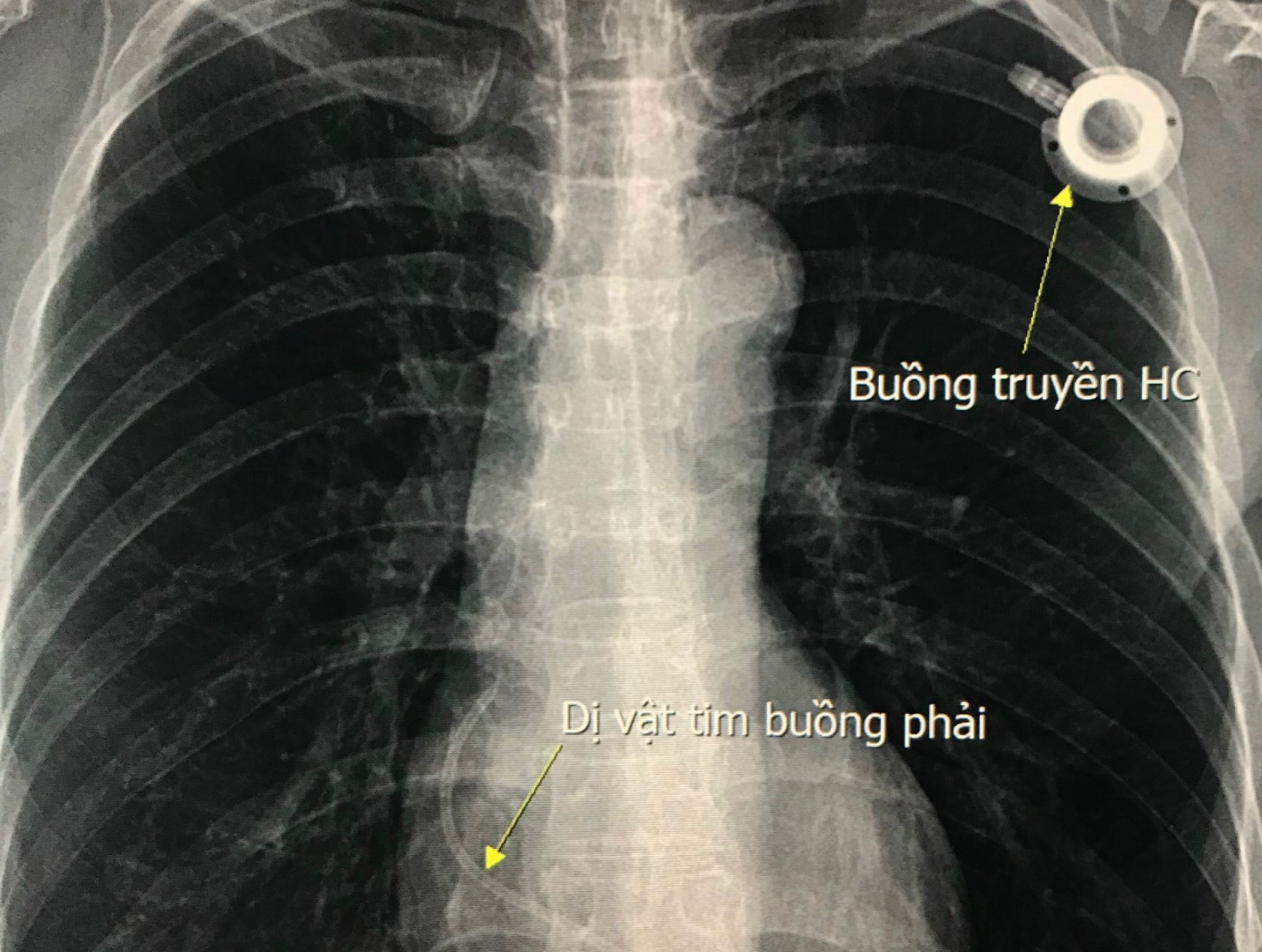 Gắp dị vật mắc kẹt ở tim nữ bệnh nhân