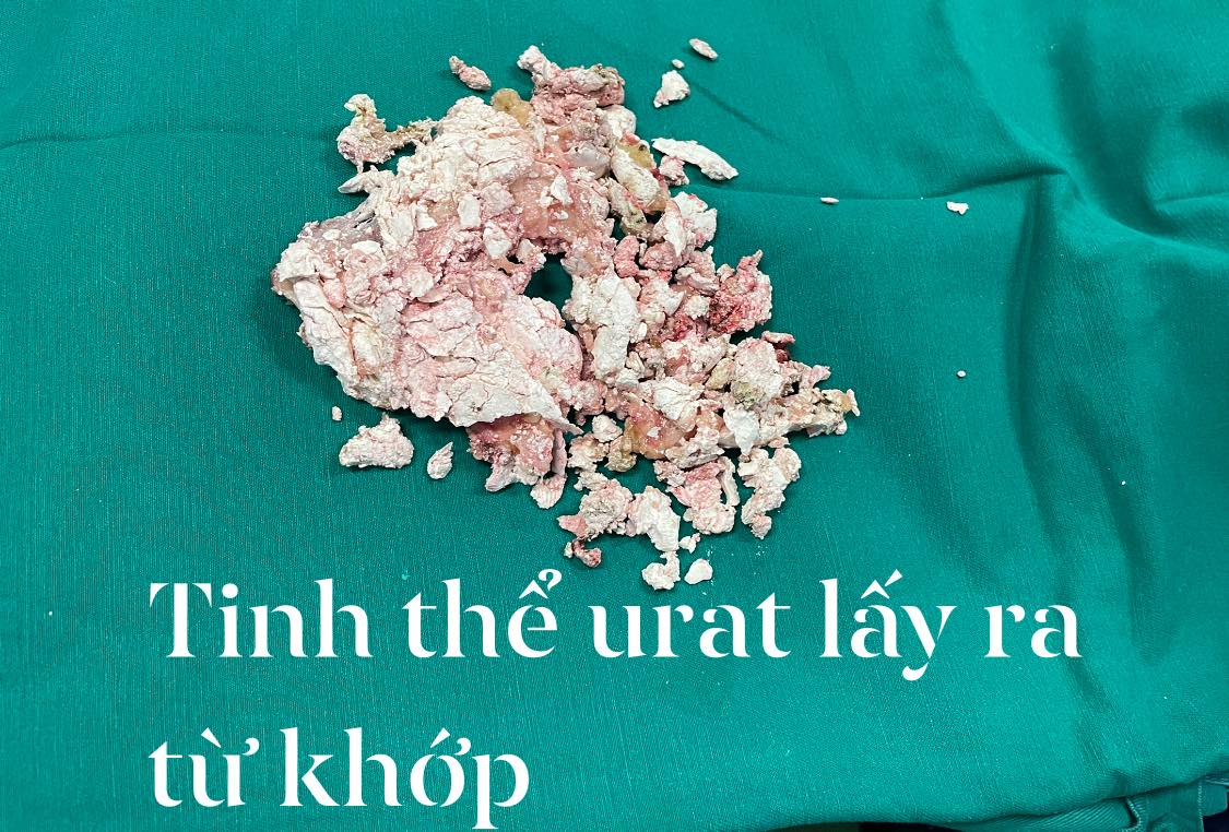 Mắc bệnh gout, nam thanh niên phải thay khớp gối 2 bên - Ảnh 2.