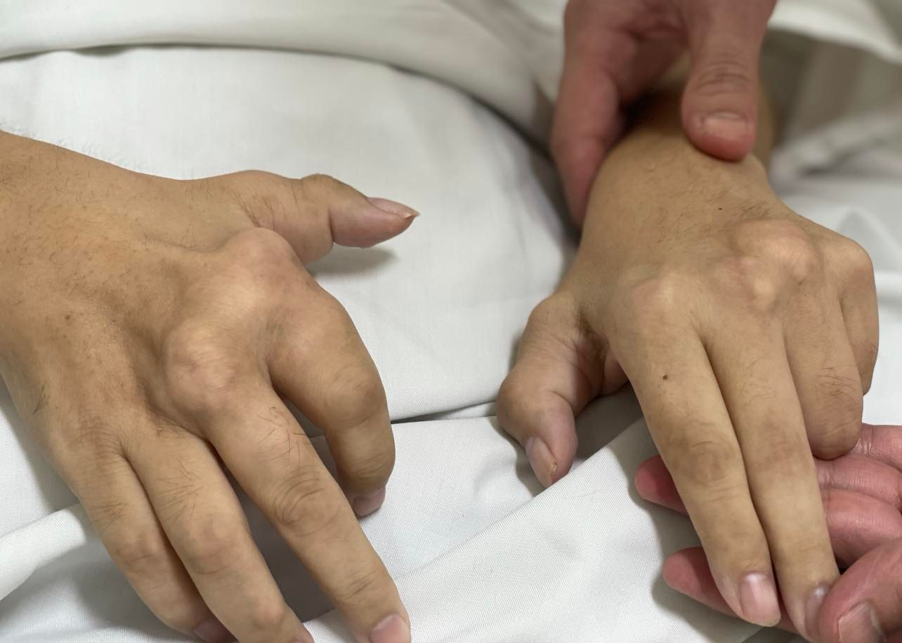 Mắc bệnh gout, nam thanh niên phải thay khớp gối cả 2 chân