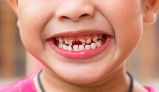 Răng sữa bị mủn vỡ đến sát lợi, có sao không?