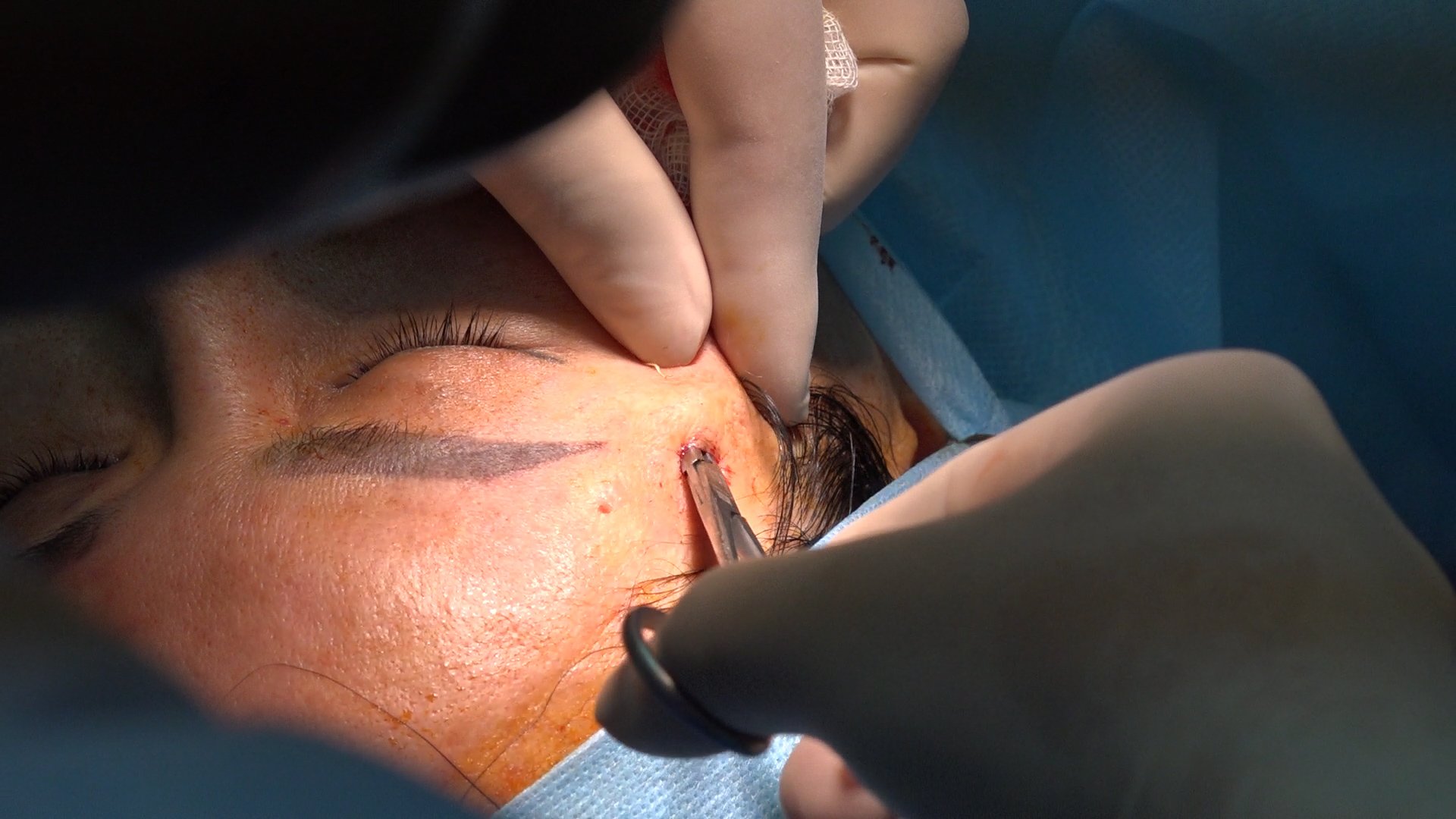 Nhiều người nhiễm trùng sau tiêm filler làm đẹp