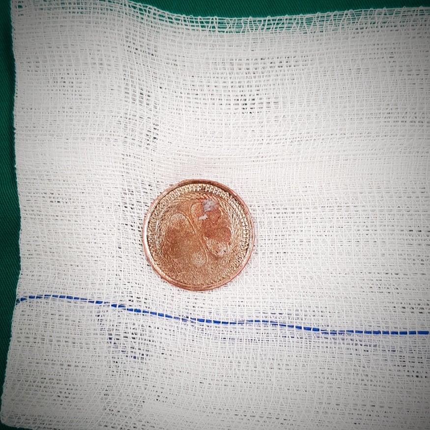 Bé gái 5 tuổi đột nhiên nôn ói nhiều vì nuốt dị vật - Ảnh 3.