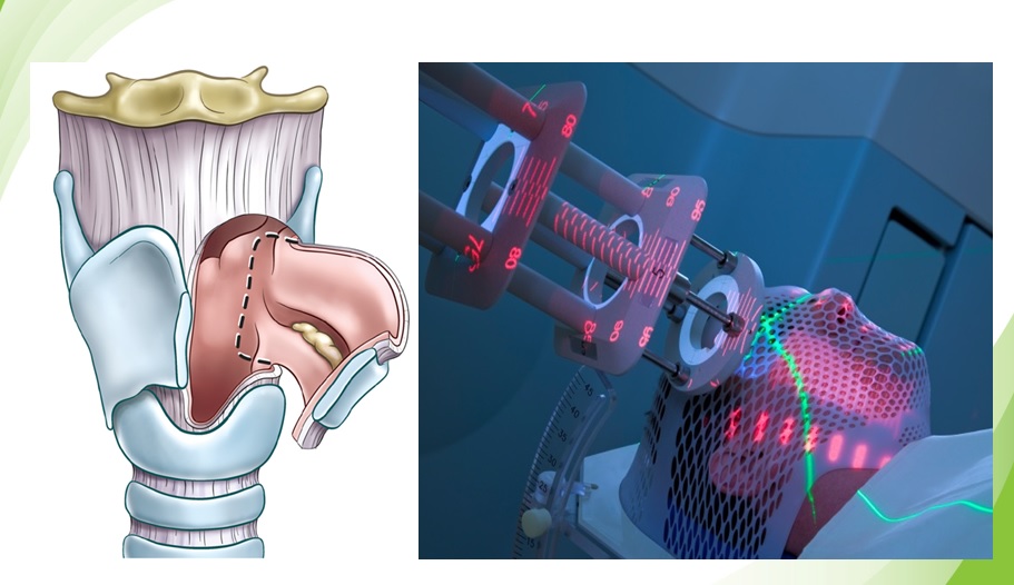Không bị tái phát khi điều trị ung thư thanh quản bằng laser vi phẫu