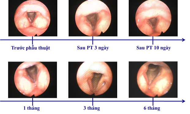 Không bị tái phát khi điều trị ung thư thanh quản bằng laser vi phẫu - Ảnh 1.