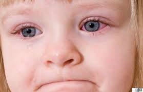 Điều trị sẹo giác mạc bẩm sinh