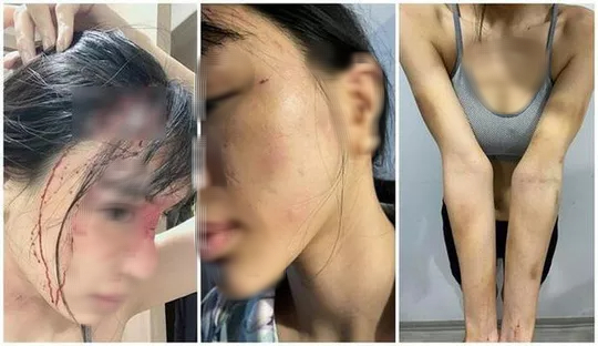 Điều tra vụ siêu mẫu Khả Trang "tố" chồng chưa cưới hành hung