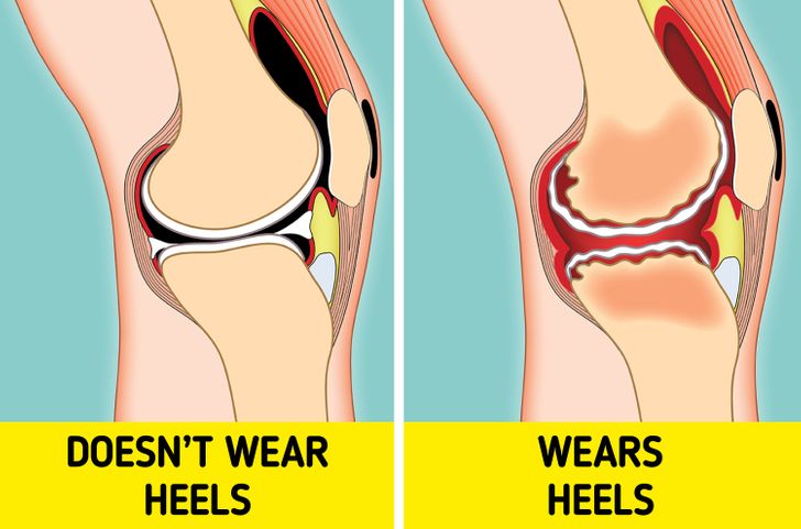 Những tác hại của việc đi giày cao gót thường xuyên - Ảnh 3.