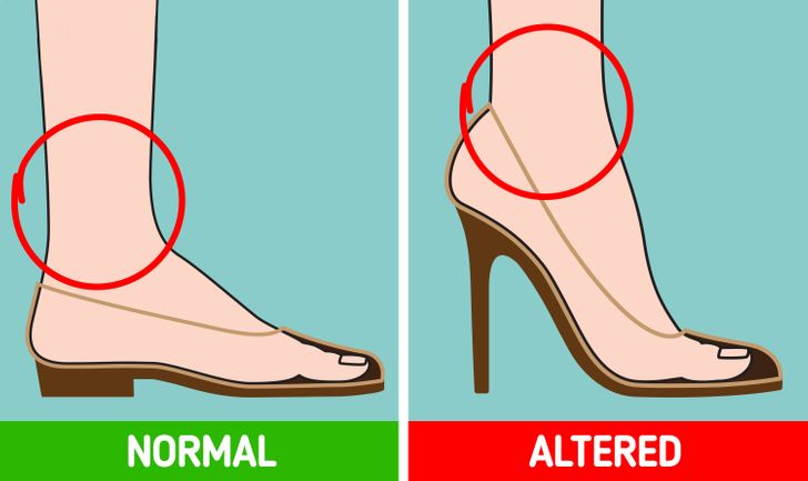 Những tác hại của việc đi giày cao gót thường xuyên - Ảnh 4.