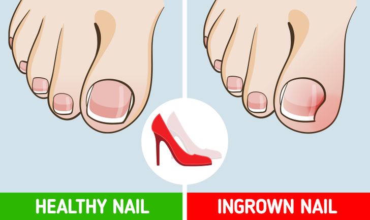 Những tác hại của việc đi giày cao gót thường xuyên - Ảnh 6.