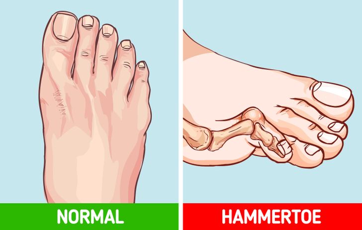 Những tác hại của việc đi giày cao gót thường xuyên - Ảnh 7.