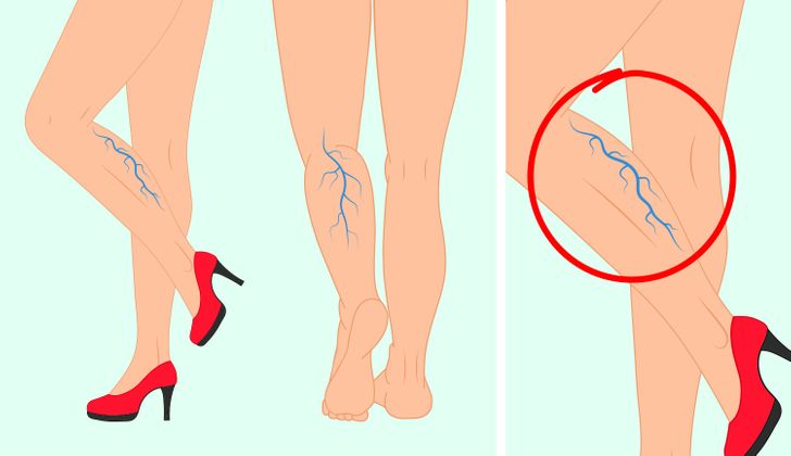 Những tác hại của việc đi giày cao gót thường xuyên - Ảnh 8.