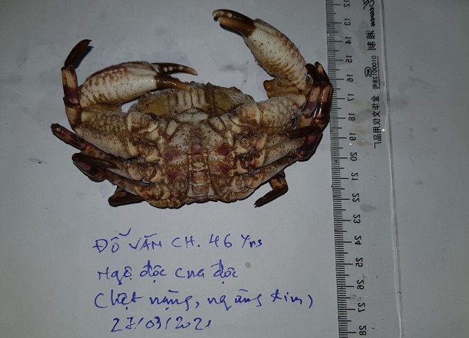 Ăn cua mặt quỷ, người đ&agrave;n &ocirc;ng bị liệt to&agrave;n th&acirc;n, ngộ độc nguy kịch - Ảnh 3.