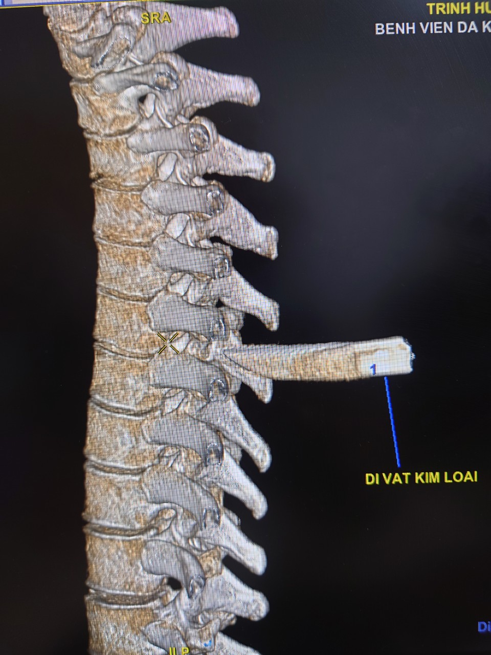 Nam thanh niên nhập viện với mũi dao đâm thẳng vào cột sống - Ảnh 1.