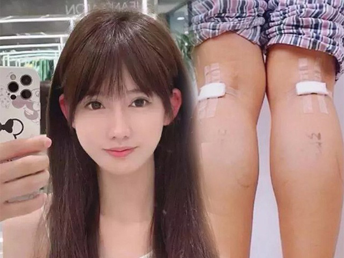 Cắt d&acirc;y thần kinh để l&agrave;m ch&acirc;n thon - phương ph&aacute;p l&agrave;m đẹp r&ugrave;ng rợn của giới trẻ - Ảnh 1.