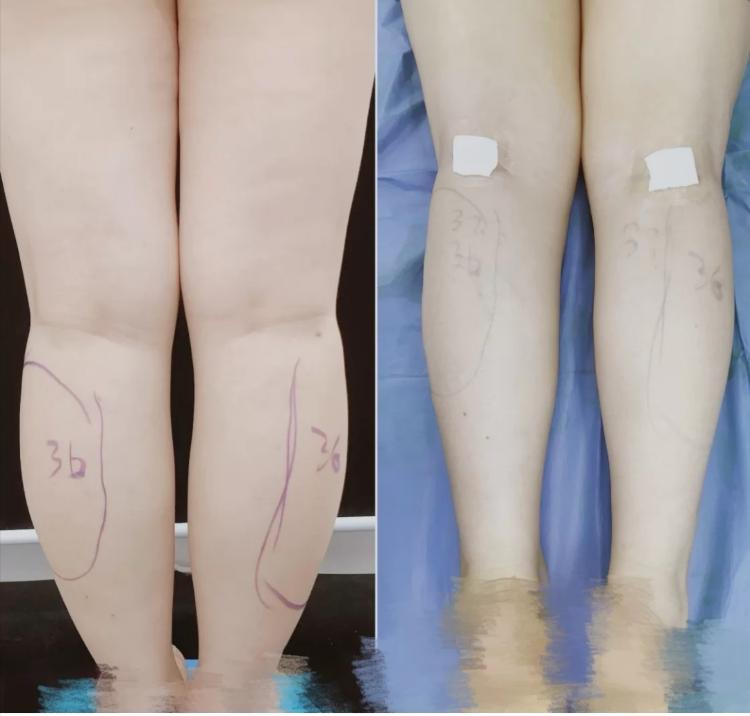 Cắt d&acirc;y thần kinh để l&agrave;m ch&acirc;n thon - phương ph&aacute;p l&agrave;m đẹp r&ugrave;ng rợn của giới trẻ - Ảnh 3.