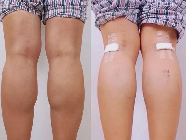 Cắt d&acirc;y thần kinh để l&agrave;m ch&acirc;n thon - phương ph&aacute;p l&agrave;m đẹp r&ugrave;ng rợn của giới trẻ - Ảnh 4.