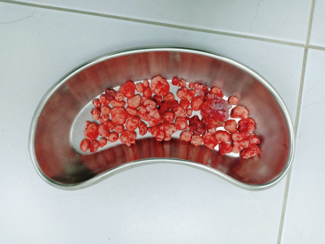 Bác sĩ bất ngờ trước 100 viên sỏi nằm trong khớp háng người đàn ông