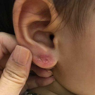 Nhiễm trùng tai do xỏ bông