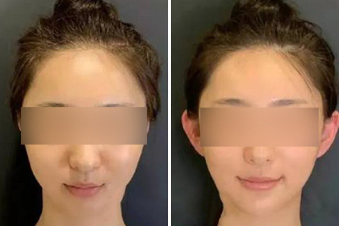 Mốt phẫu thuật thẩm mỹ 'tai yêu tinh' bùng nổ ở Trung Quốc
