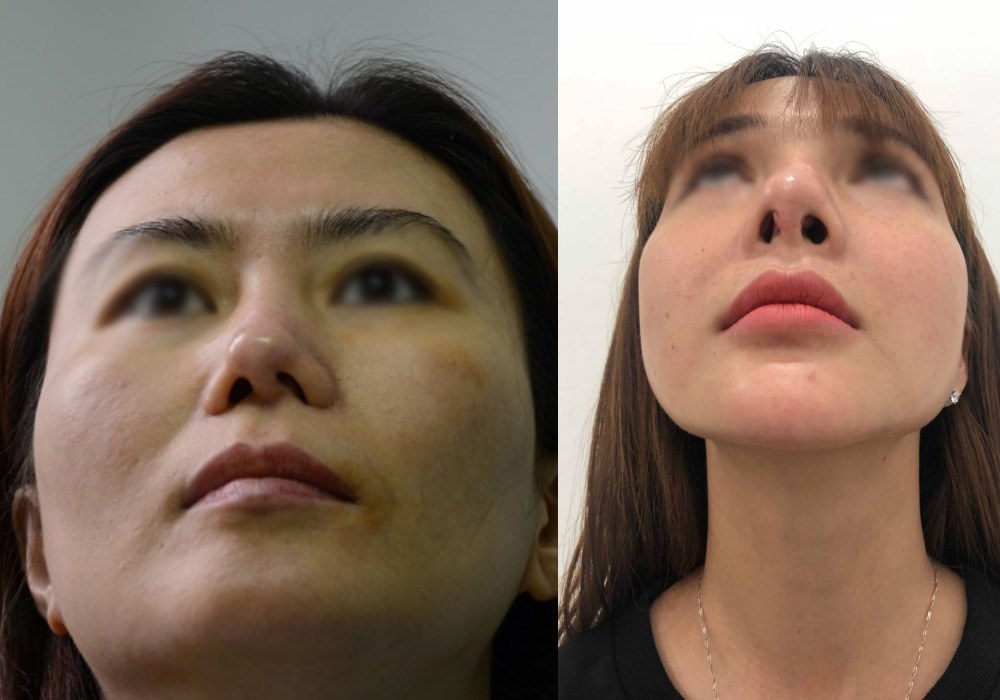 Dao k&eacute;o hỏng: Nỗi khổ của bệnh nh&acirc;n v&agrave; c&aacute;i kh&oacute; của b&aacute;c sĩ - Ảnh 2.